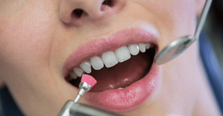porcelain veneer