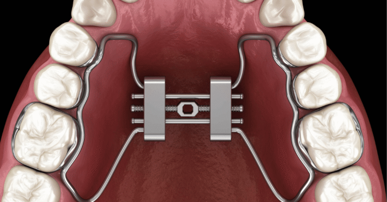 expander