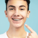 ceramic braces