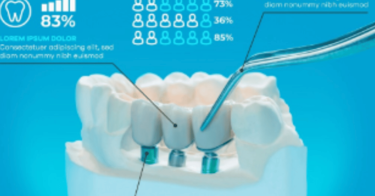 molar teeth implant