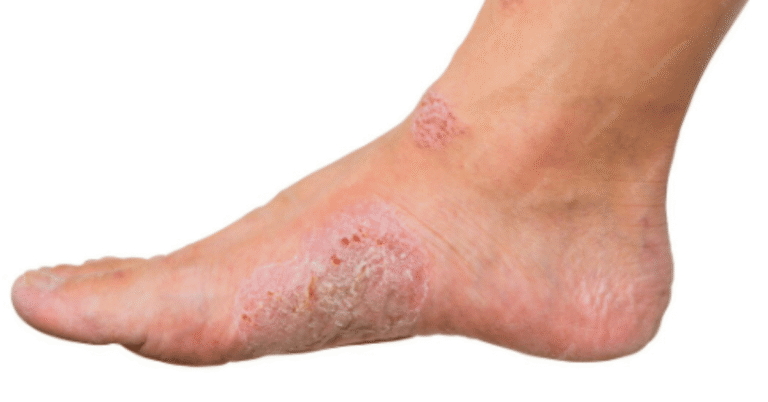 corn versus callus