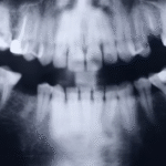 jaw bone tori