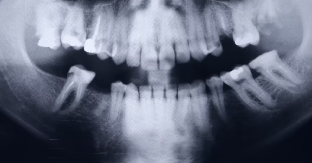 jaw bone tori